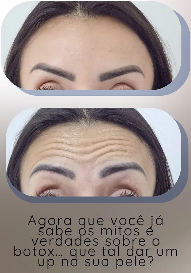 botox antes e depois