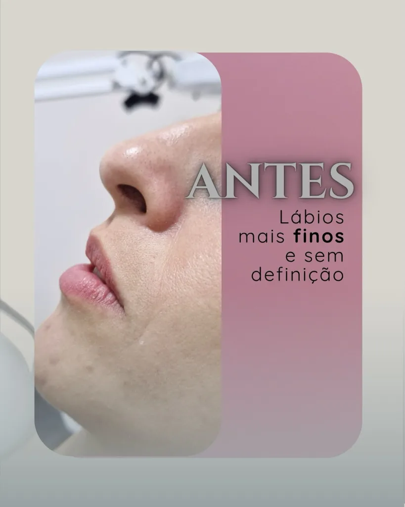 labios antes