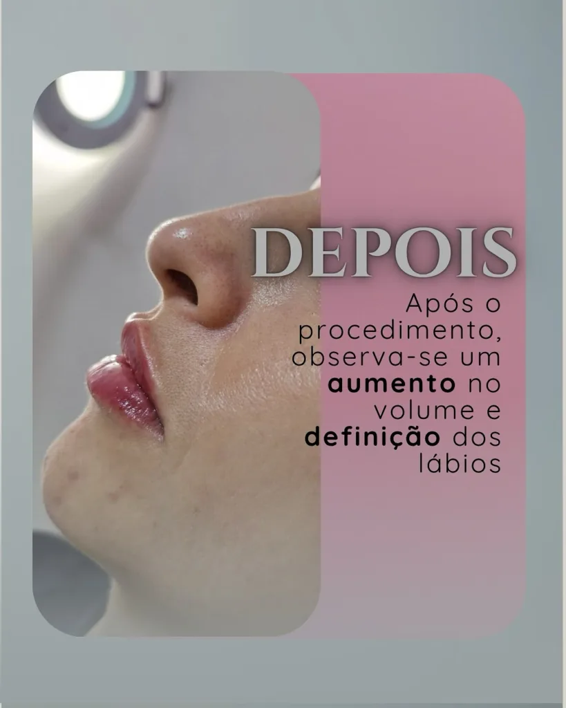 labios depois
