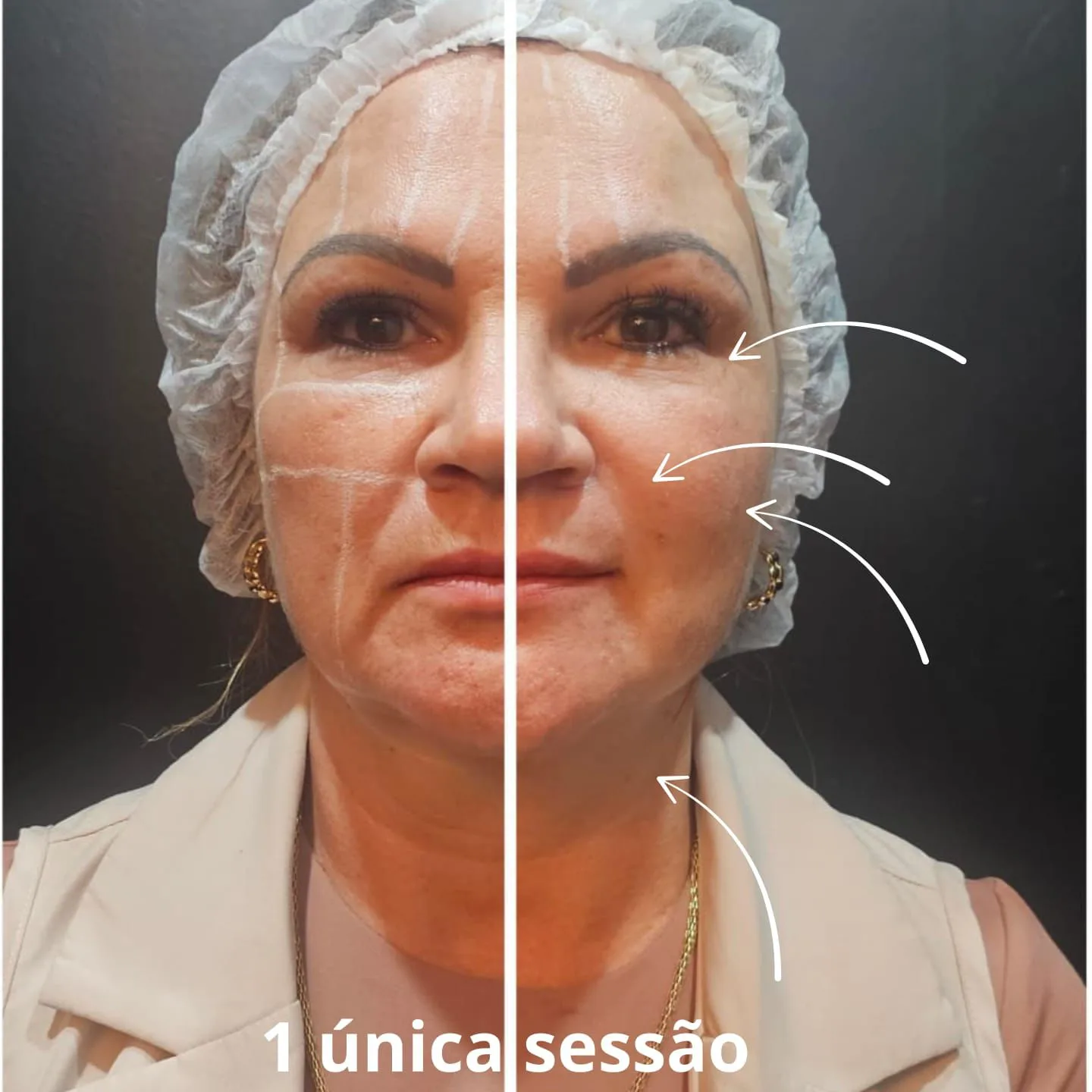 Hipro Lifting Moema Antes Depois