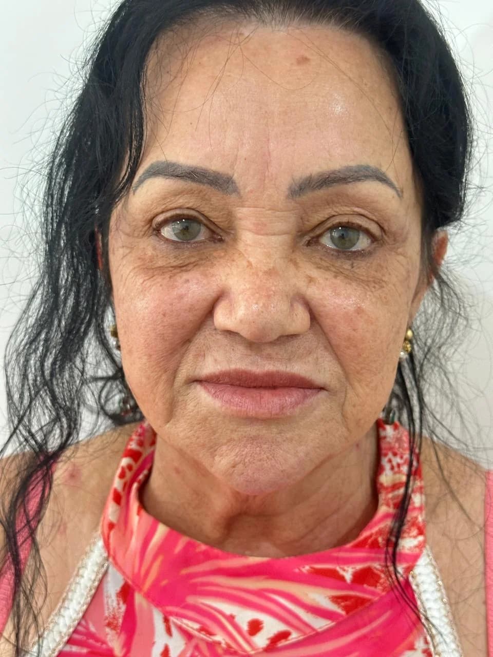 antes do tratamento HIFU para bigode chinês em Moema SP — Dra. Talita Almeida