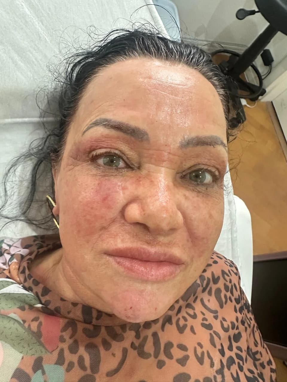 depois do tratamento HIFU para bigode chinês em Moema SP — Dra. Talita Almeida