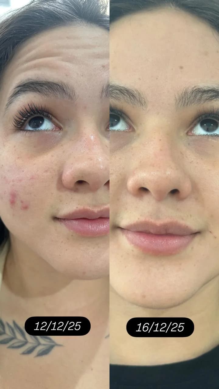 Resultado de toxina botulínica na testa em Moema SP — Dra. Talita Almeida