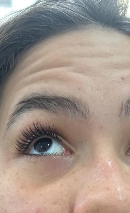 Linhas de expressão na testa antes da toxina botulínica — Dra. Talita Almeida Moema