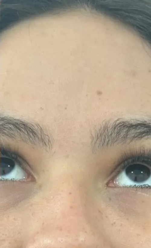 Testa sem rugas após toxina botulínica — Dra. Talita Almeida Moema