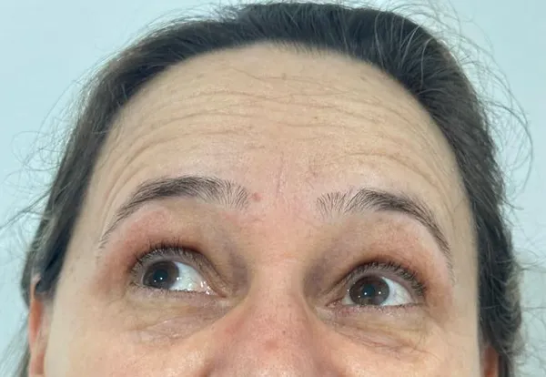 Testa com rugas antes da toxina botulínica em Moema SP — Dra. Talita Almeida