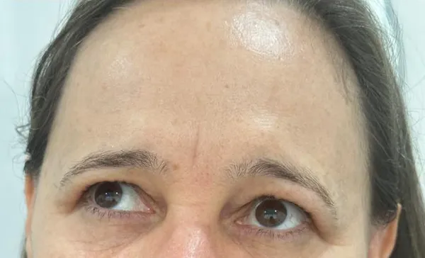 Testa lisa após toxina botulínica em Moema SP — Dra. Talita Almeida