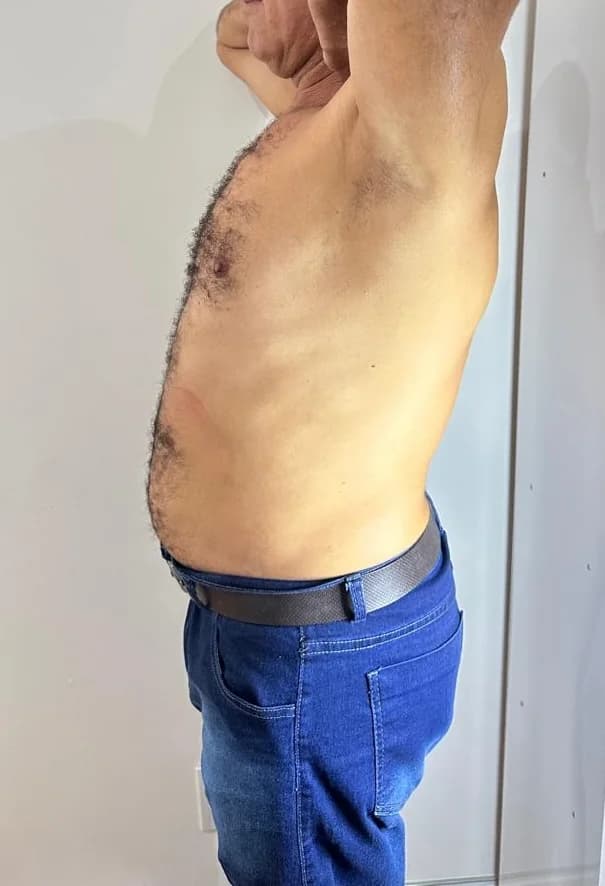 Emagrecimento - Depois