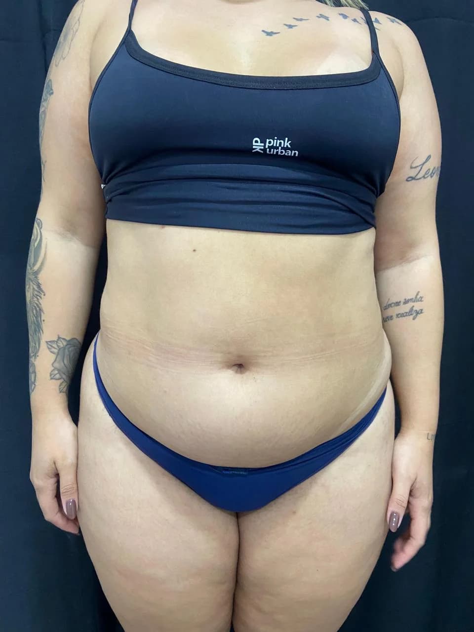 Endolaser — Caso 3 - Antes