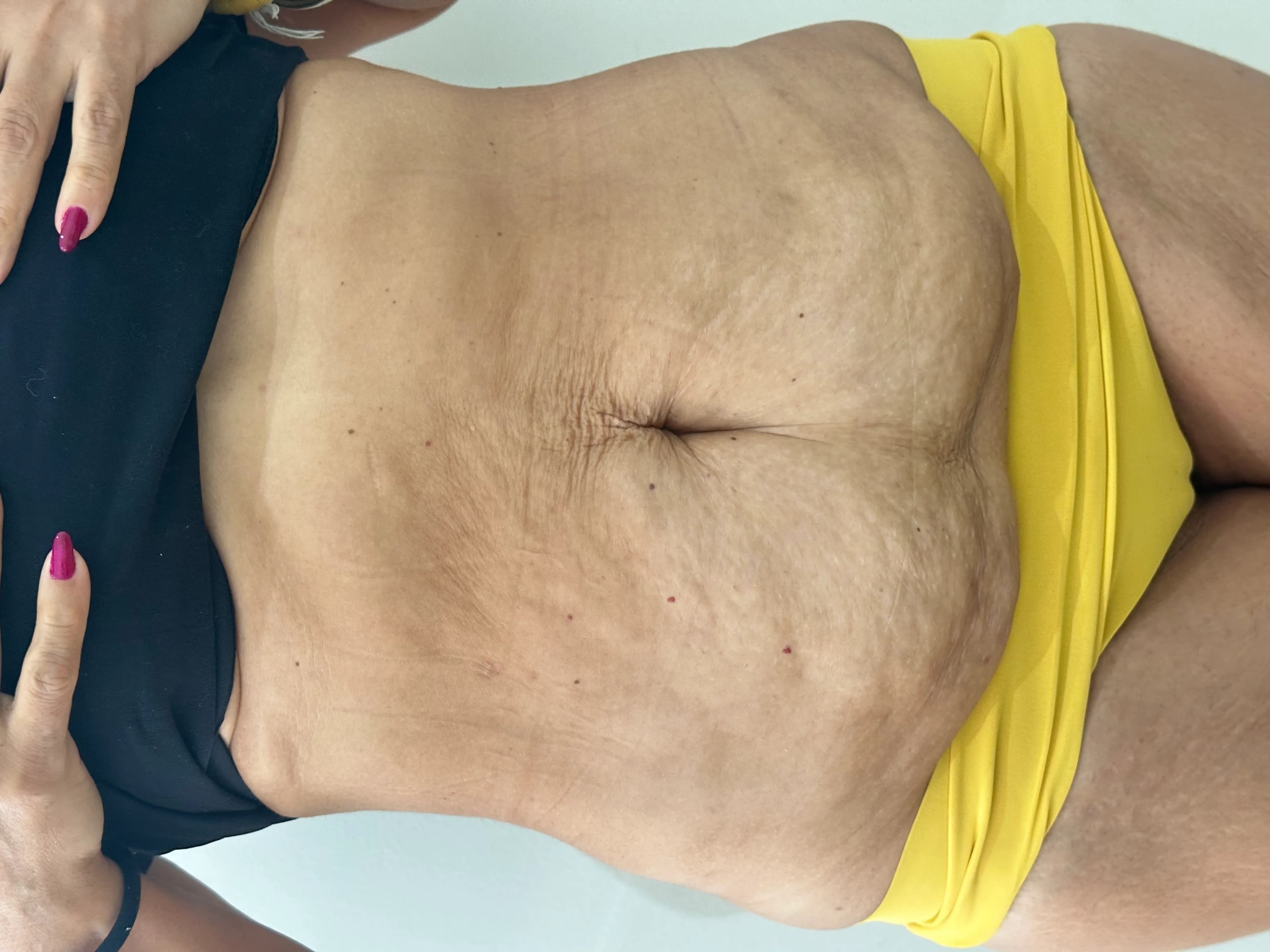 Endolaser Barriga — 1 Semana de Tratamento - Antes