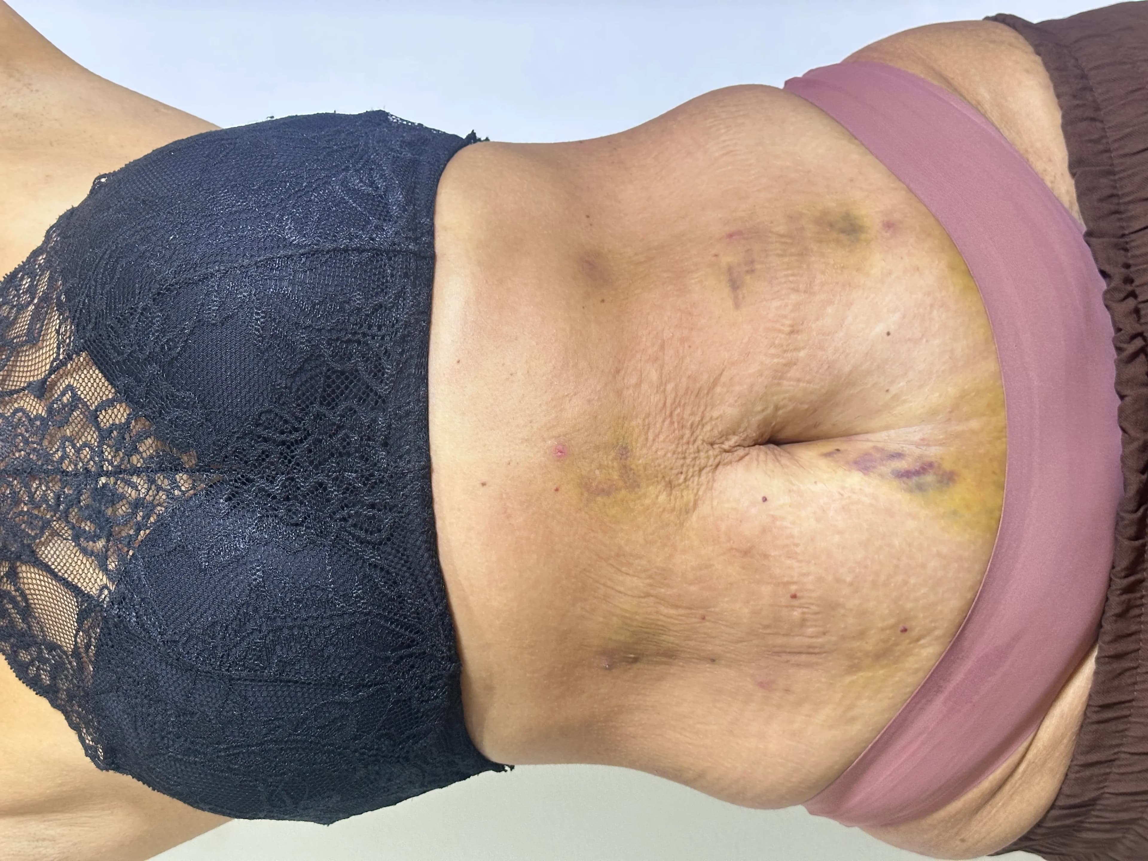 Endolaser Barriga — 1 Semana - Depois