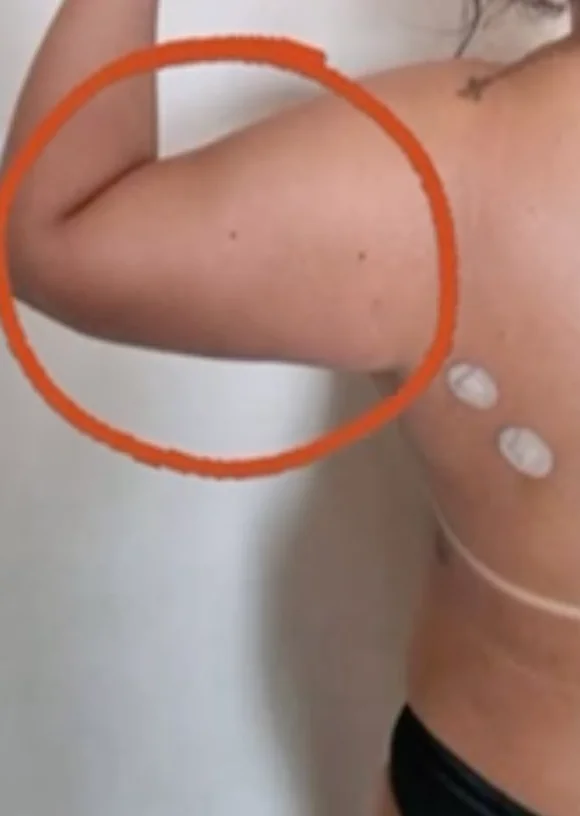 Endolaser Braço — antes e depois - Antes