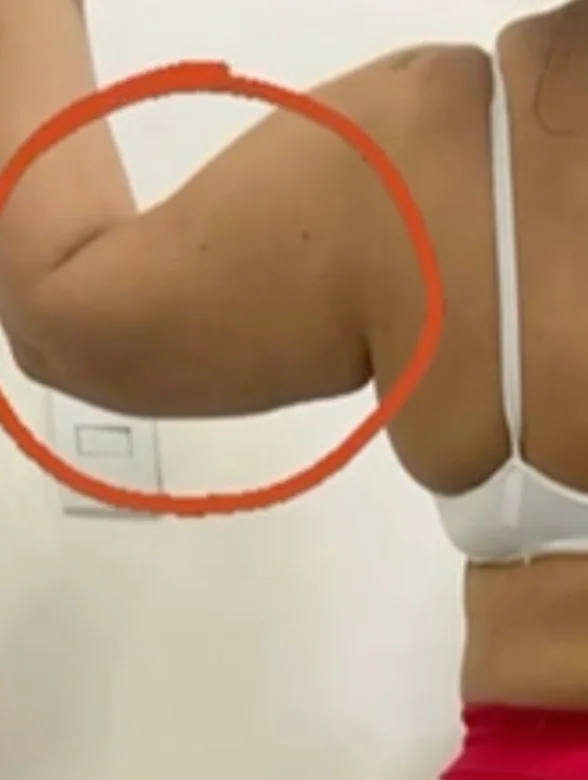Endolaser Braço — antes e depois - Depois