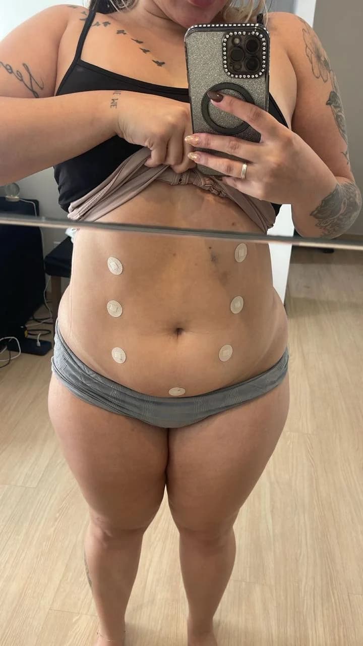 Endolaser Abdômen — antes e depois - Depois