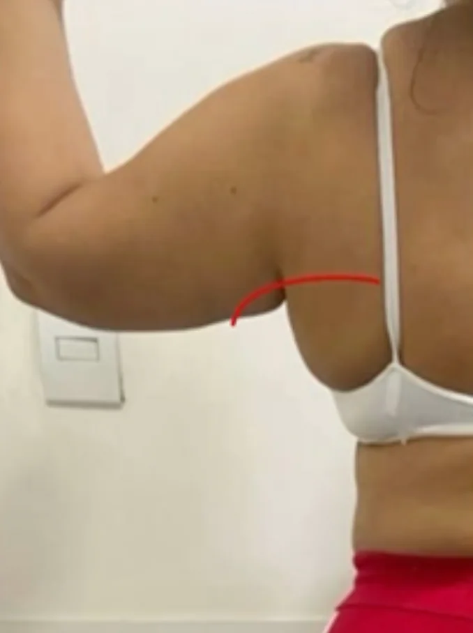Endolaser Dorso — antes e depois - Antes