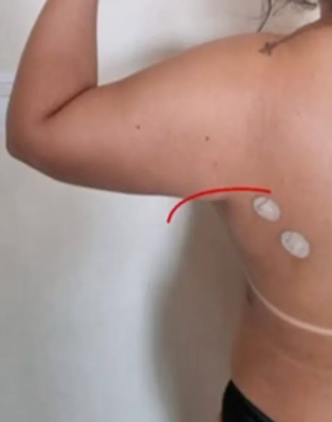 Endolaser Dorso — antes e depois - Depois