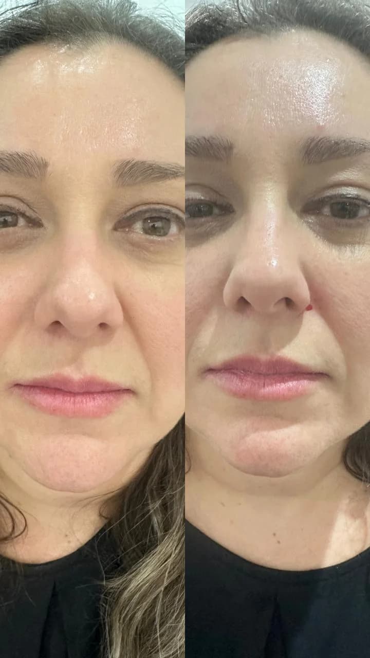 Antes e depois de fios de PDO para redução de expressões faciais em Moema SP — Dra. Talita Almeida