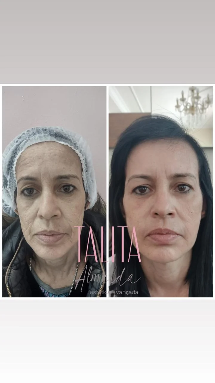 Antes e depois Harmonização Facial — Caso 1 em Moema SP — Dra. Talita Almeida