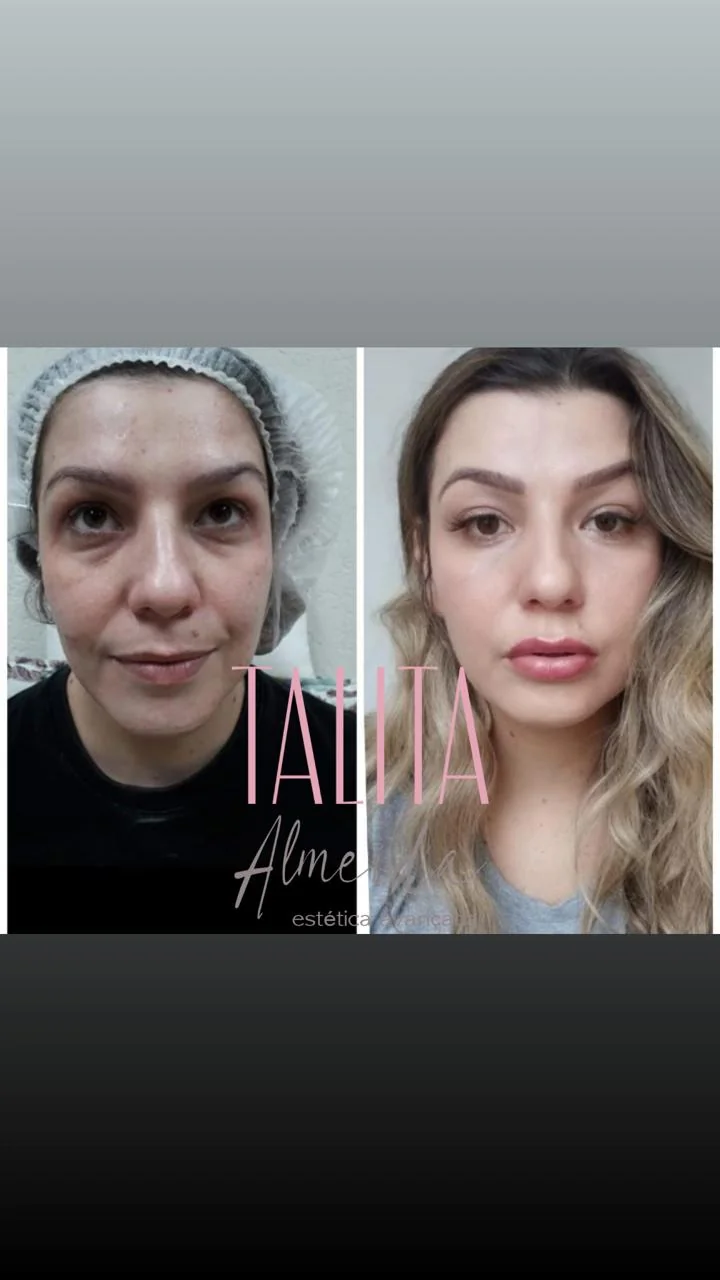 Antes e depois Harmonização Facial — Caso 2 em Moema SP — Dra. Talita Almeida