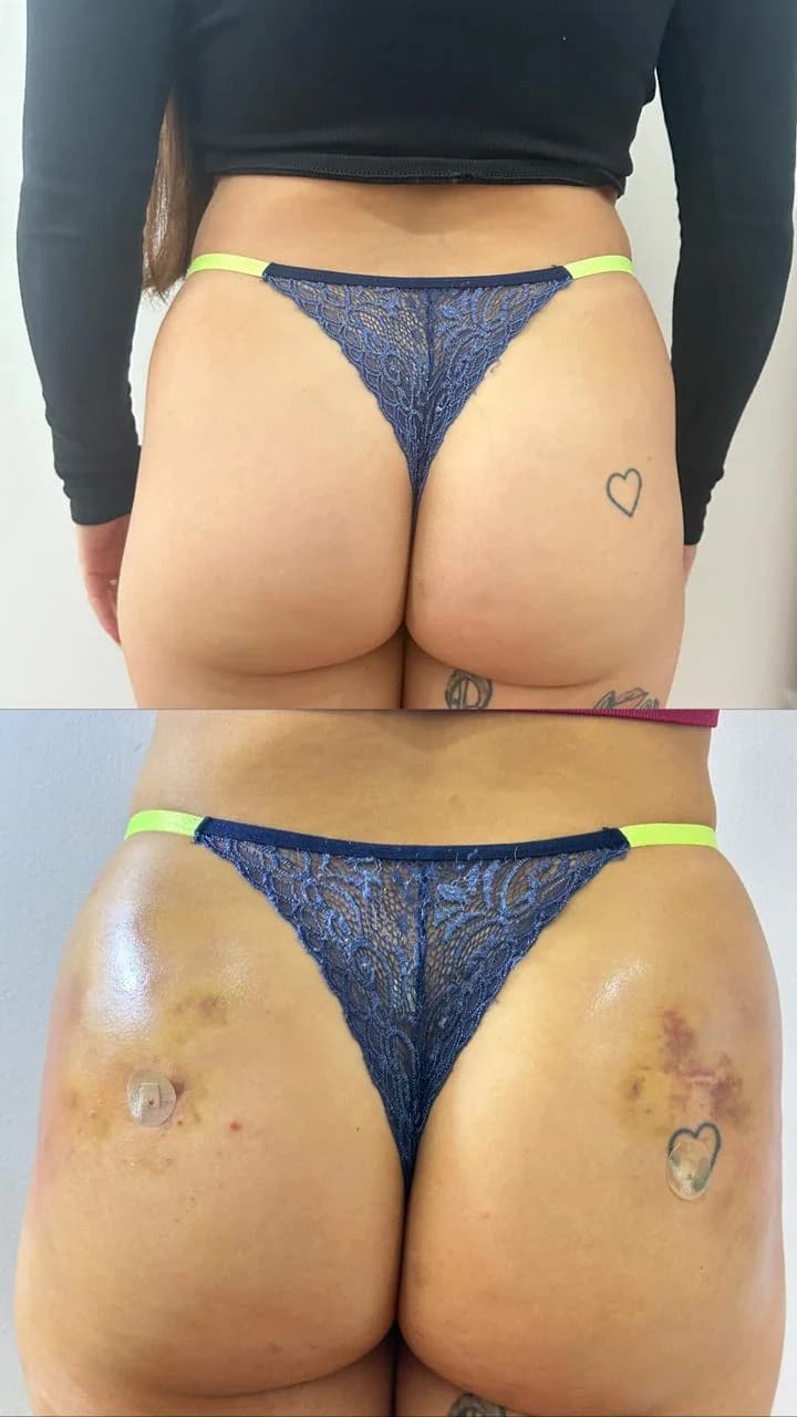 Resultado de harmonização glútea antes e depois — caso 3 — Dra. Talita Almeida Moema SP