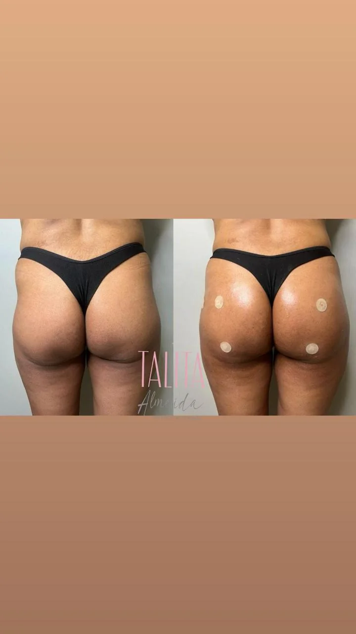 antes e depois de harmonização glútea caso 4 em Moema SP — Dra. Talita Almeida