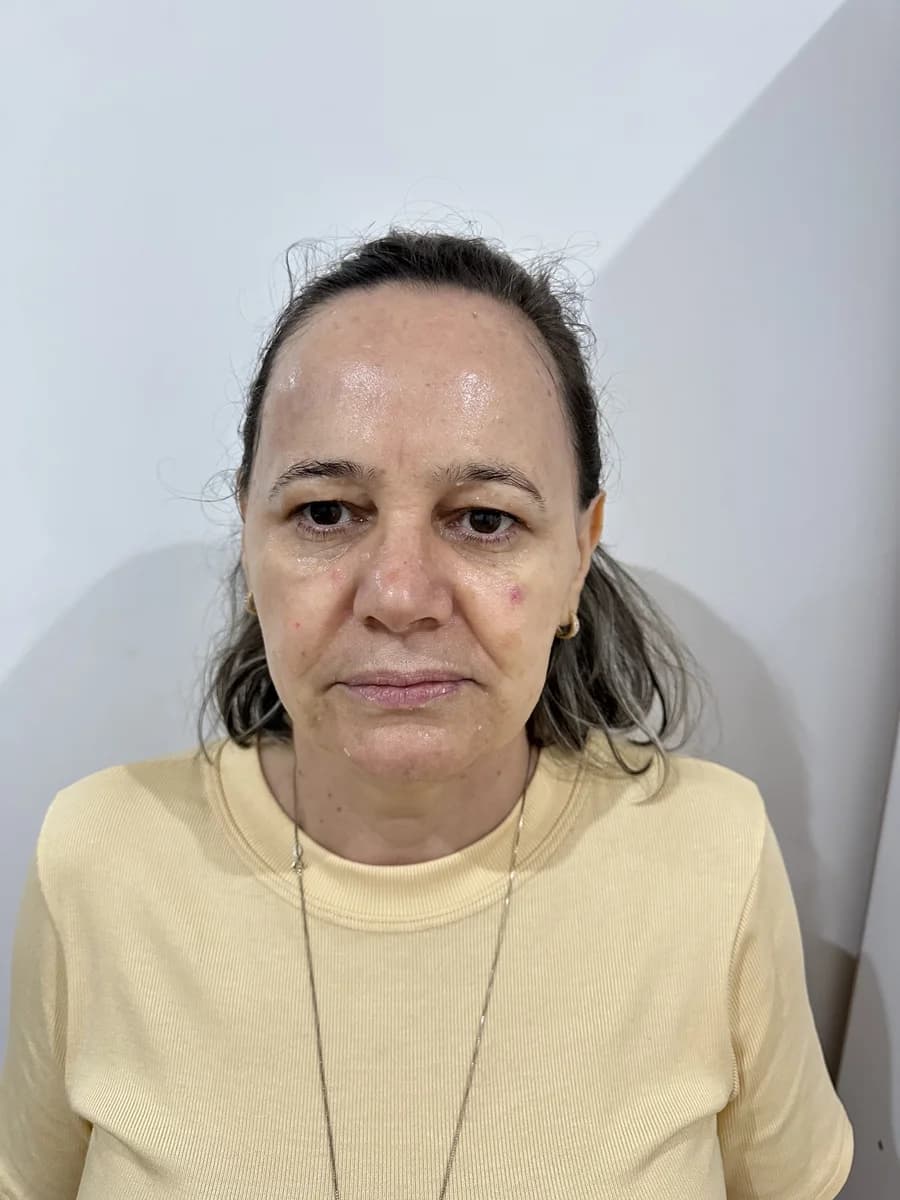 CO₂ + HIFU Multilinear — rosto - Antes