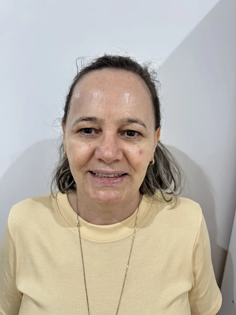 CO₂ + HIFU Multilinear — rosto - Depois