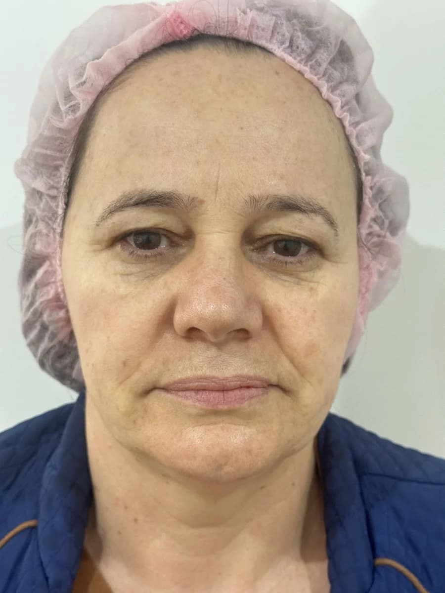 HIFU Papada — antes e depois - Antes