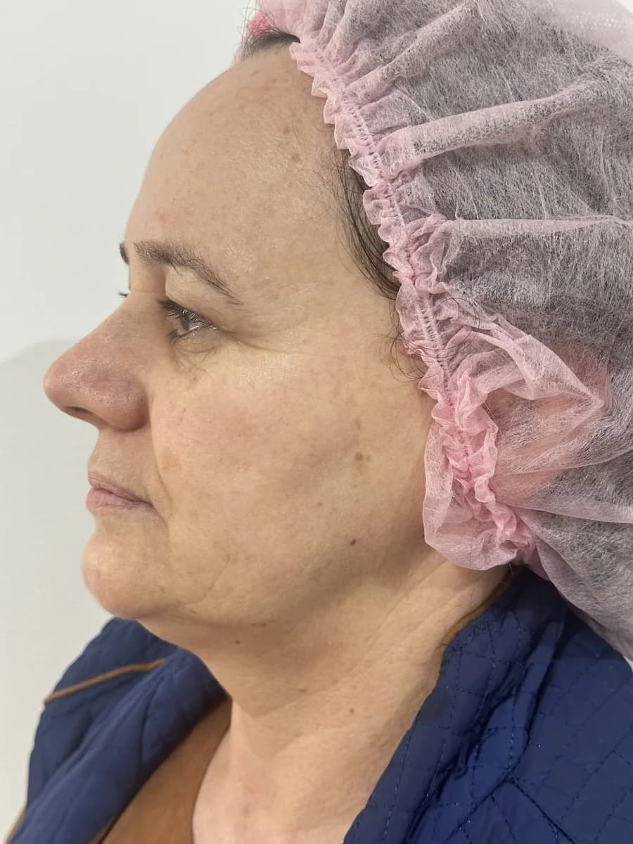 HIFU Papada — antes e depois - Depois