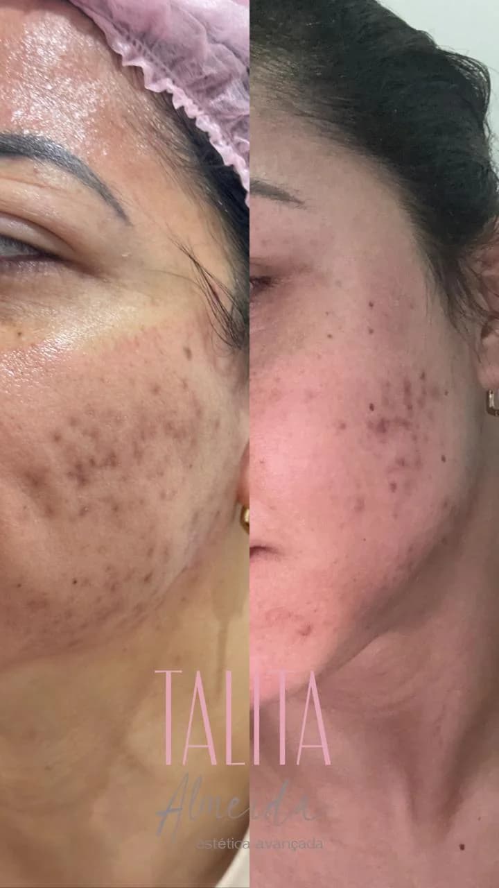 Antes e depois Tratamento de Manchas e Cicatrizes em Moema SP — Dra. Talita Almeida