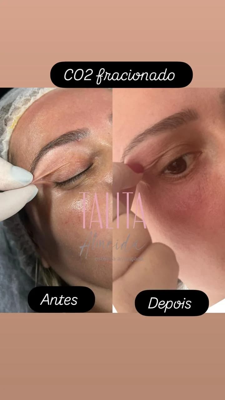 Antes e depois Rejuvenescimento Palpebral em Moema SP — Dra. Talita Almeida