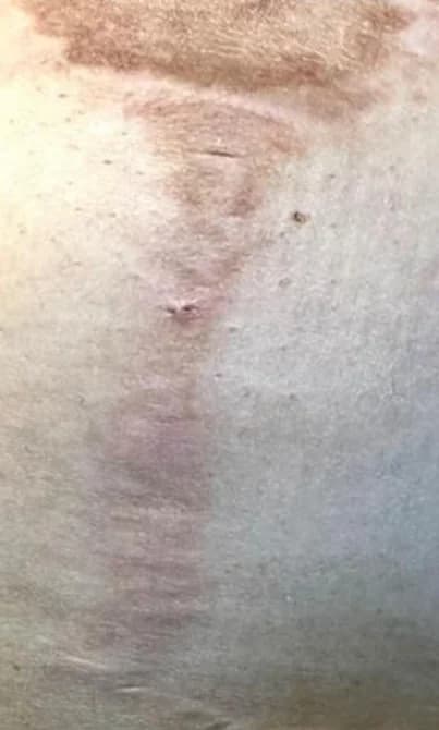 Laser CO2 Corporal Antes — Estrias e cicatrizes em Moema SP