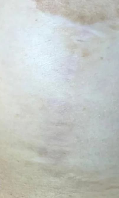 Laser CO2 Corporal Depois — Estrias e cicatrizes em Moema SP