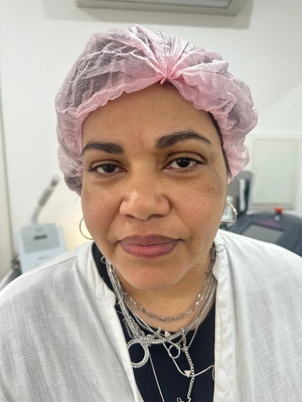 antes do microagulhamento facial em Moema SP — Dra. Talita Almeida