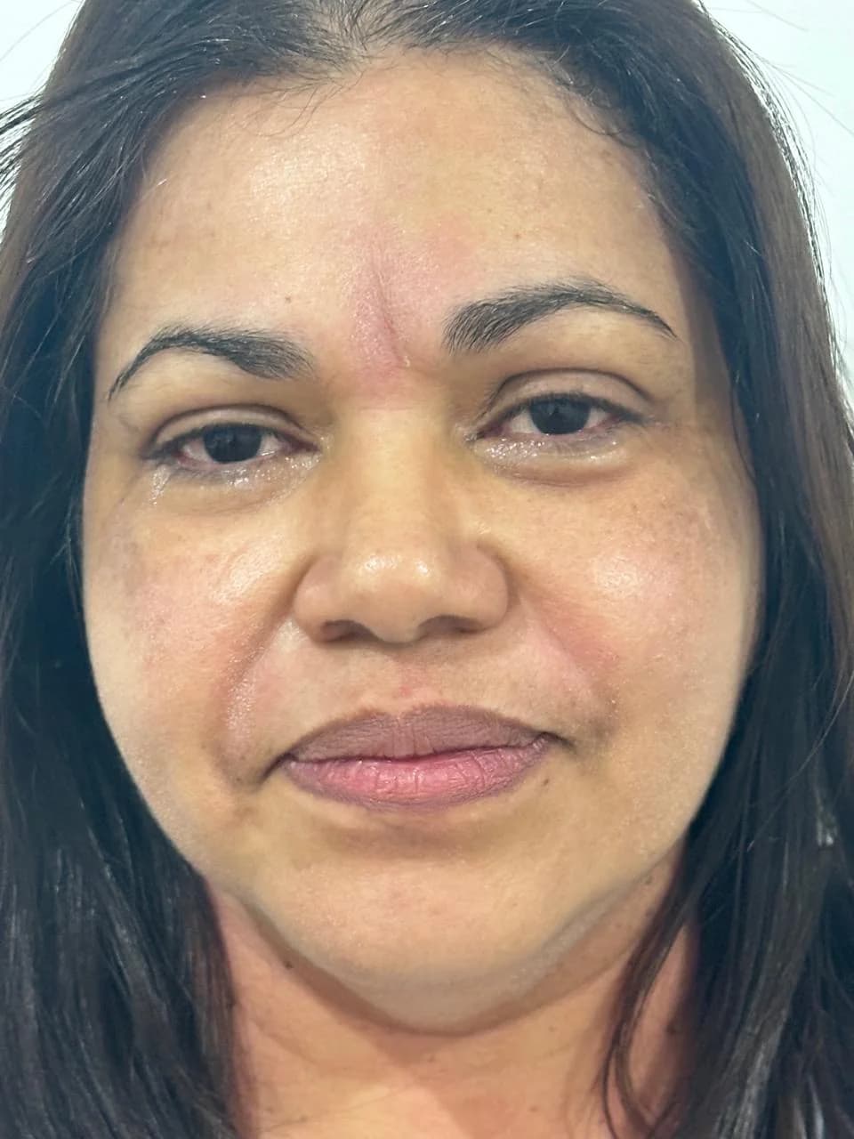 depois do microagulhamento facial em Moema SP — resultado de textura e luminosidade
