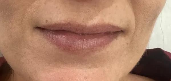 Lábios antes do preenchimento Caso 1 — Aumento e Definição — Dra. Talita Almeida Moema