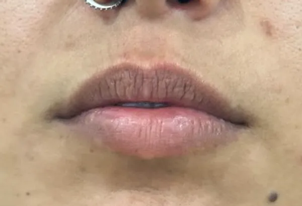 Lábios antes do preenchimento Caso 2 — Volume e Contorno — Dra. Talita Almeida Moema