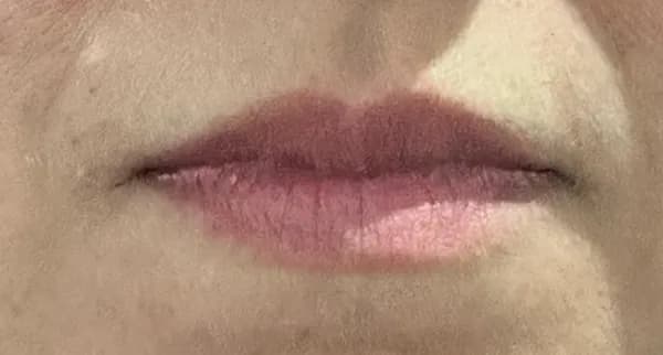 Lábios antes do preenchimento Caso 3 — Harmonização Labial — Dra. Talita Almeida Moema
