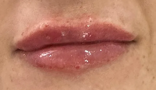 Lábios após preenchimento Caso 1 — Aumento e Definição — Dra. Talita Almeida Moema