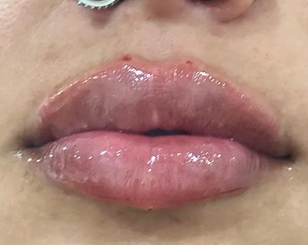 Lábios após preenchimento Caso 2 — Volume e Contorno — Dra. Talita Almeida Moema