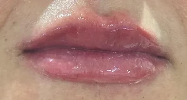 Lábios após preenchimento Caso 3 — Harmonização Labial — Dra. Talita Almeida Moema