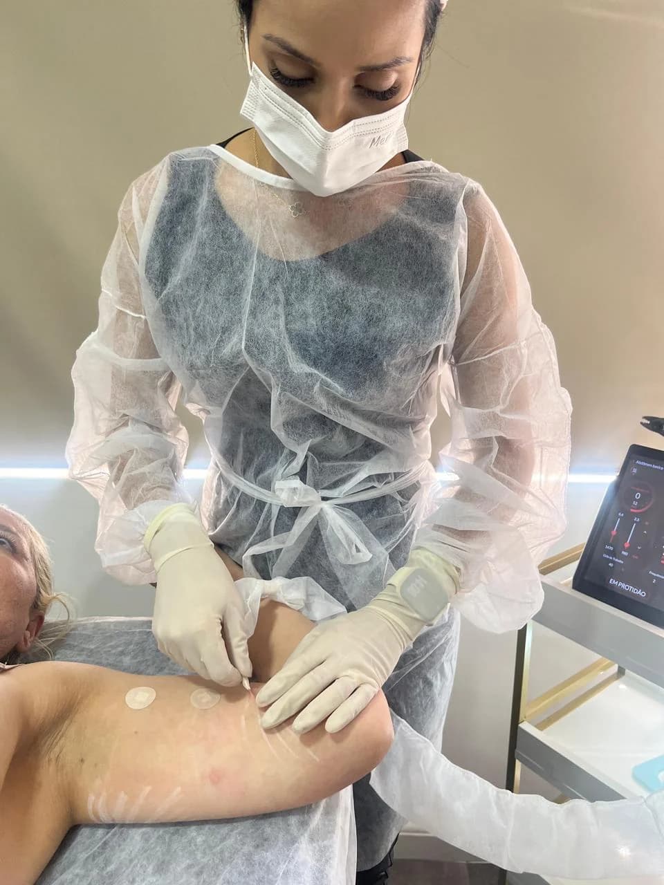 Dra. Talita Almeida realizando procedimento de Endolaser em Moema SP