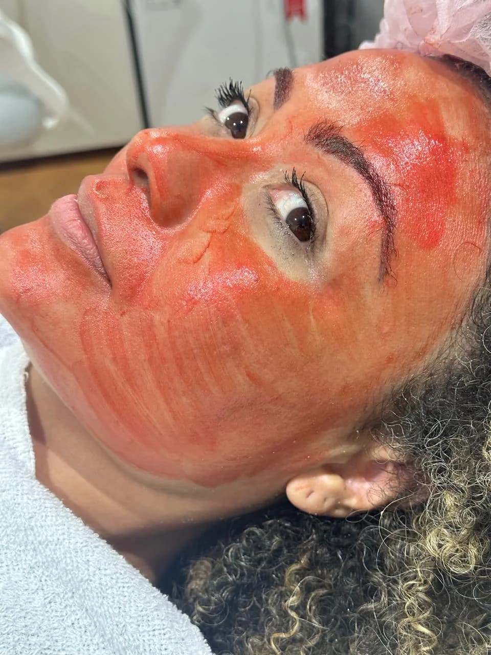 Procedimento de microagulhamento facial em Moema SP — Dra. Talita Almeida