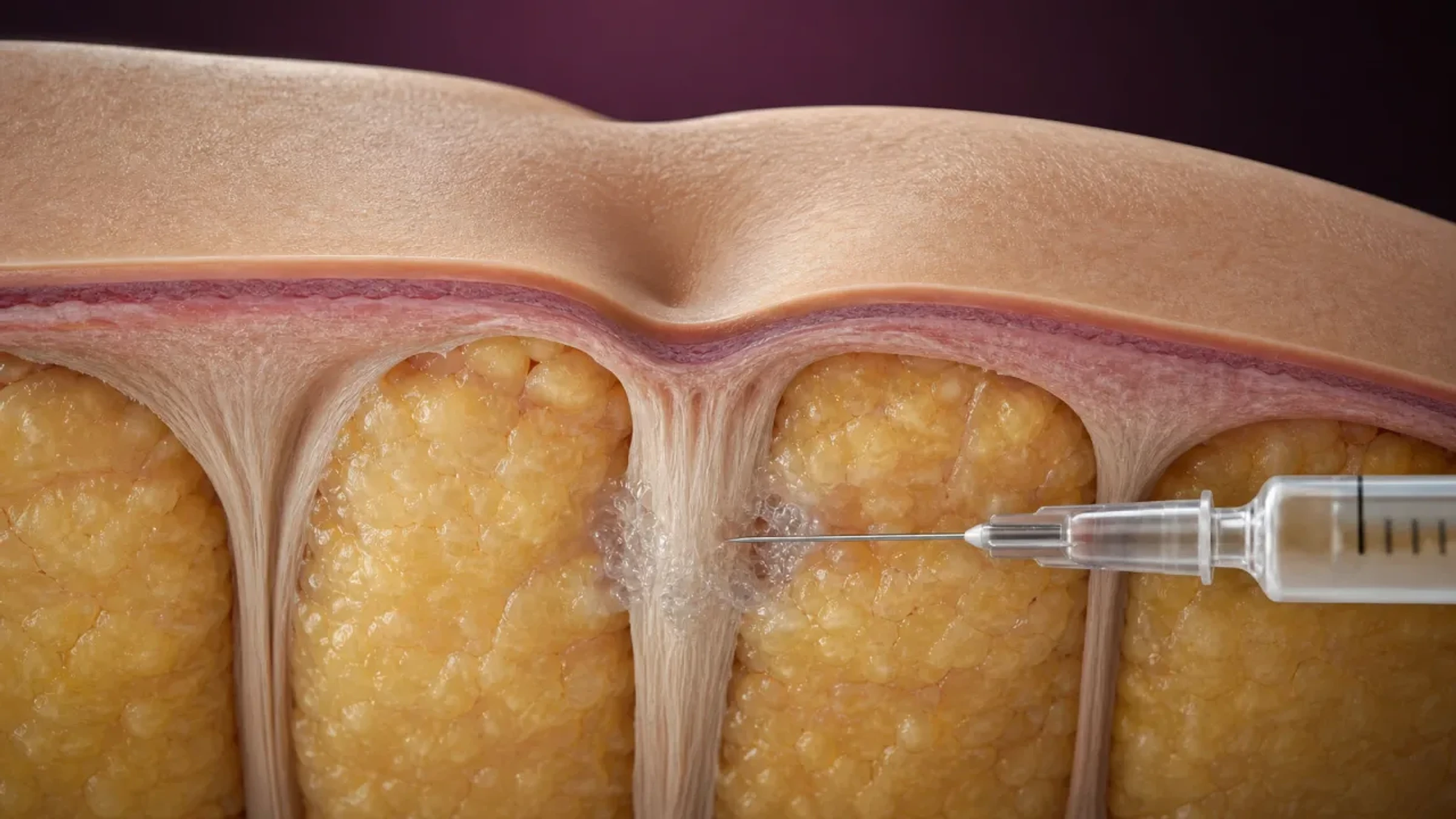Corte anatômico da celulite com injeção localizada de colagenase junto ao septo fibroso