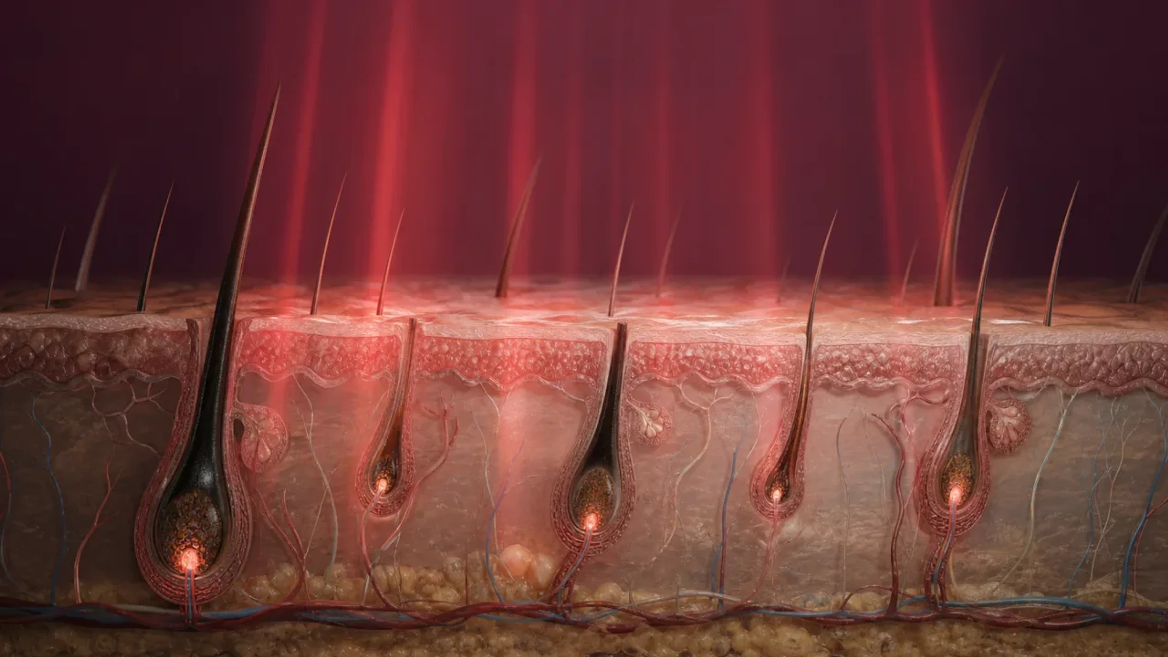 Fotobiomodulação com luz vermelha alcançando folículos pilosos viáveis em diferentes graus de miniaturização