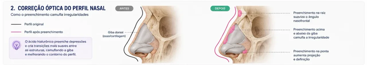 Correção óptica do perfil nasal por preenchimento com ácido hialurônico