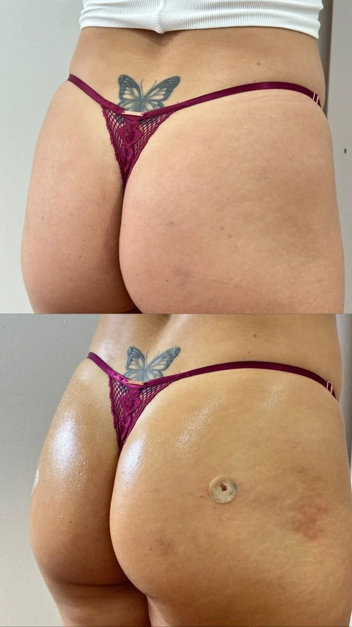 Harmonização glútea antes e depois — vista lateral