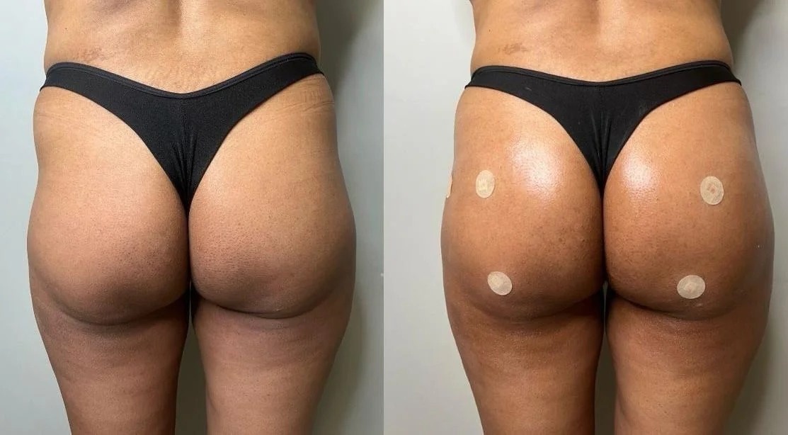 Harmonização glútea antes e depois — vista posterior