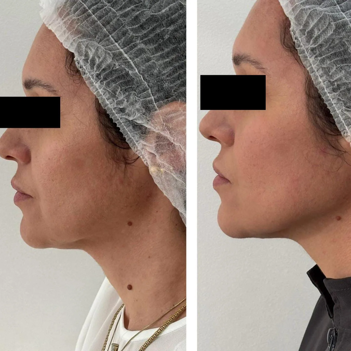 Antes e Depois HIPRO 2