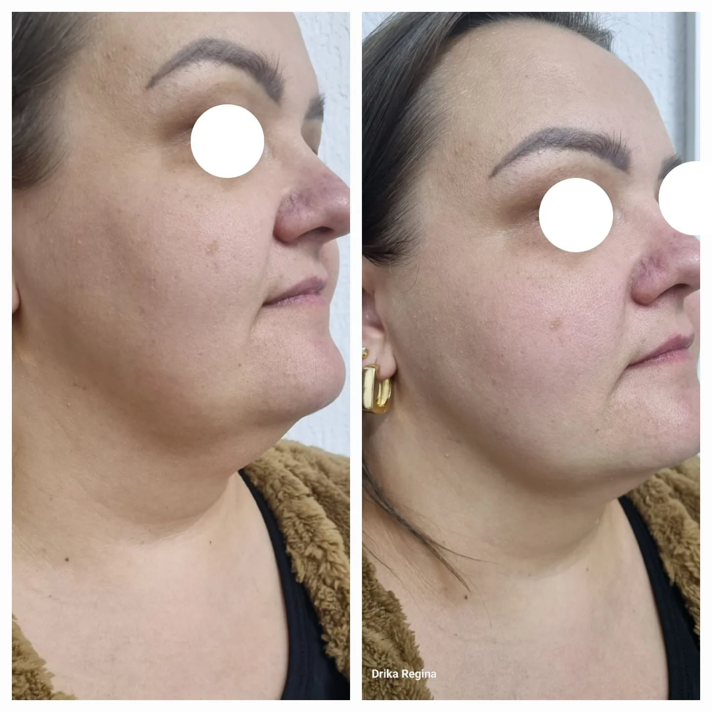 Antes e Depois HIPRO 3